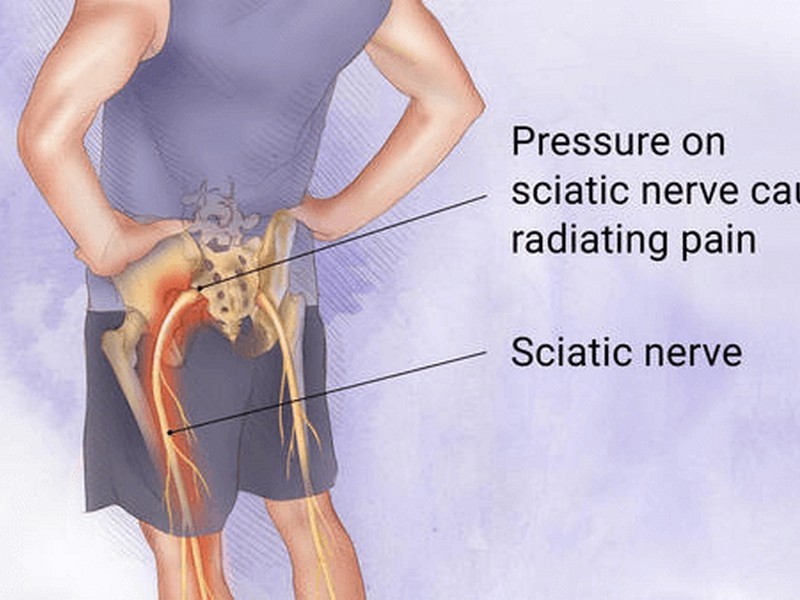 Sciatica Stiffness Southport Chiropractic Near Me